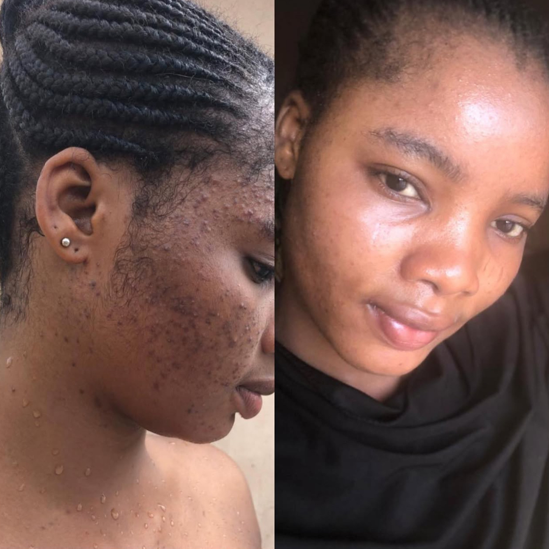 Side-by-side comparison of a person's face before and after using fyre skin 