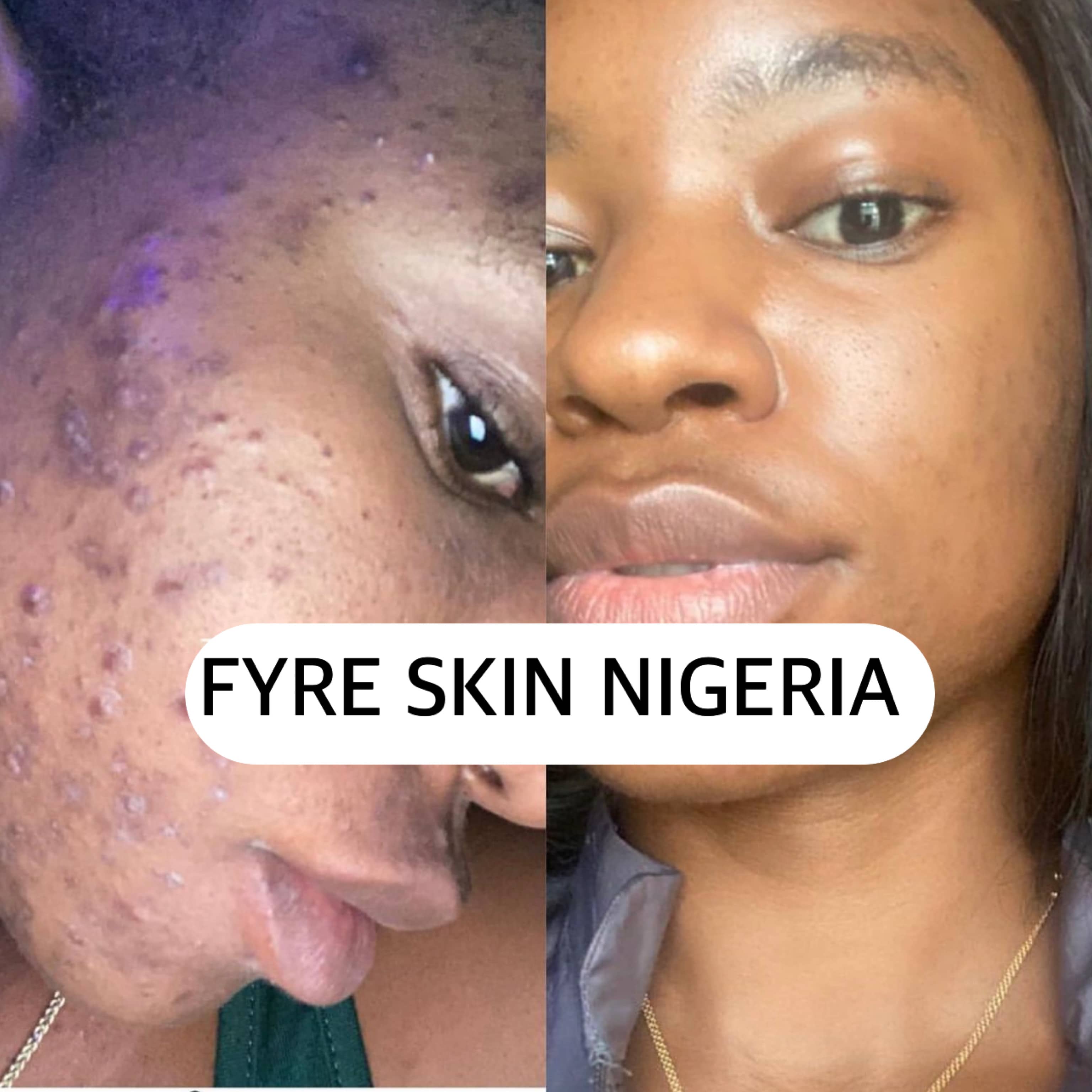 Before and After; Skin Care Routine with Fyre Skin - Best face skin care products